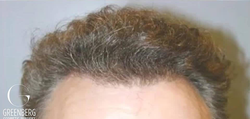 NeoGraft After, Male 50 - 3062