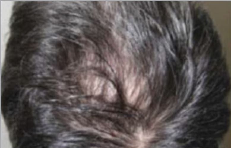 Hair Restoration Before, Male 42 - 3035
