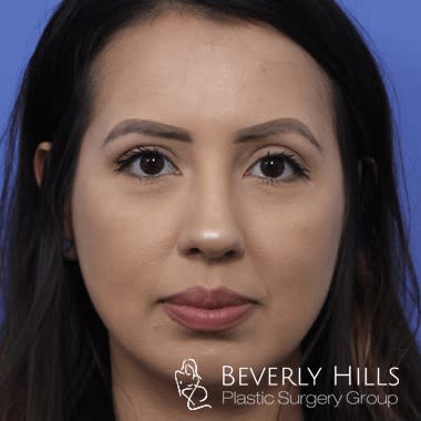 Rhinoplasty After, Female 32 - 4583