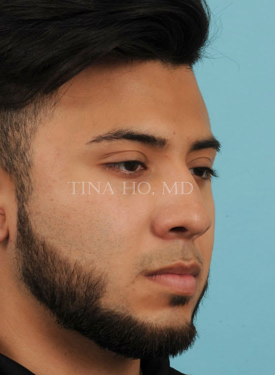 Rhinoplasty After, Male 27 - 3111