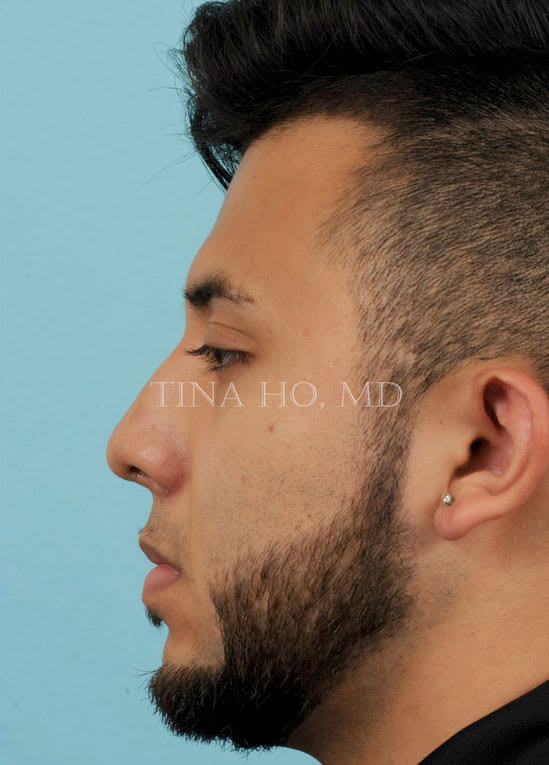 Rhinoplasty After, Male 27 - 3113