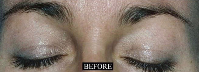 Blepharoplasty Before, Female 33 - 2154