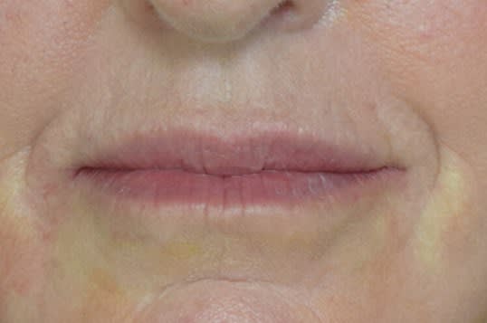 Restylane® After, Female 66 - 2187