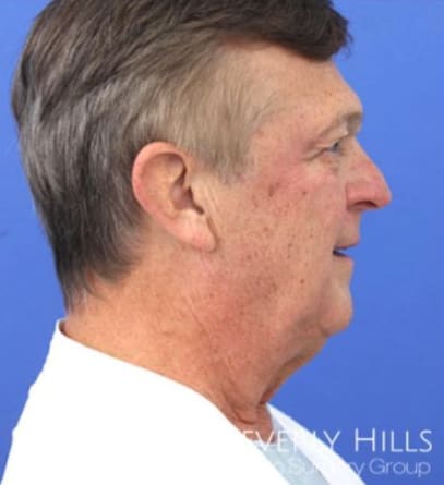 Neck Lift Before, Male 62 - 2933