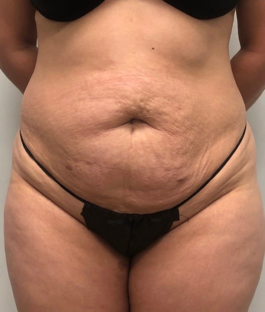 Abdominoplasty Before, Female 32 - 2861