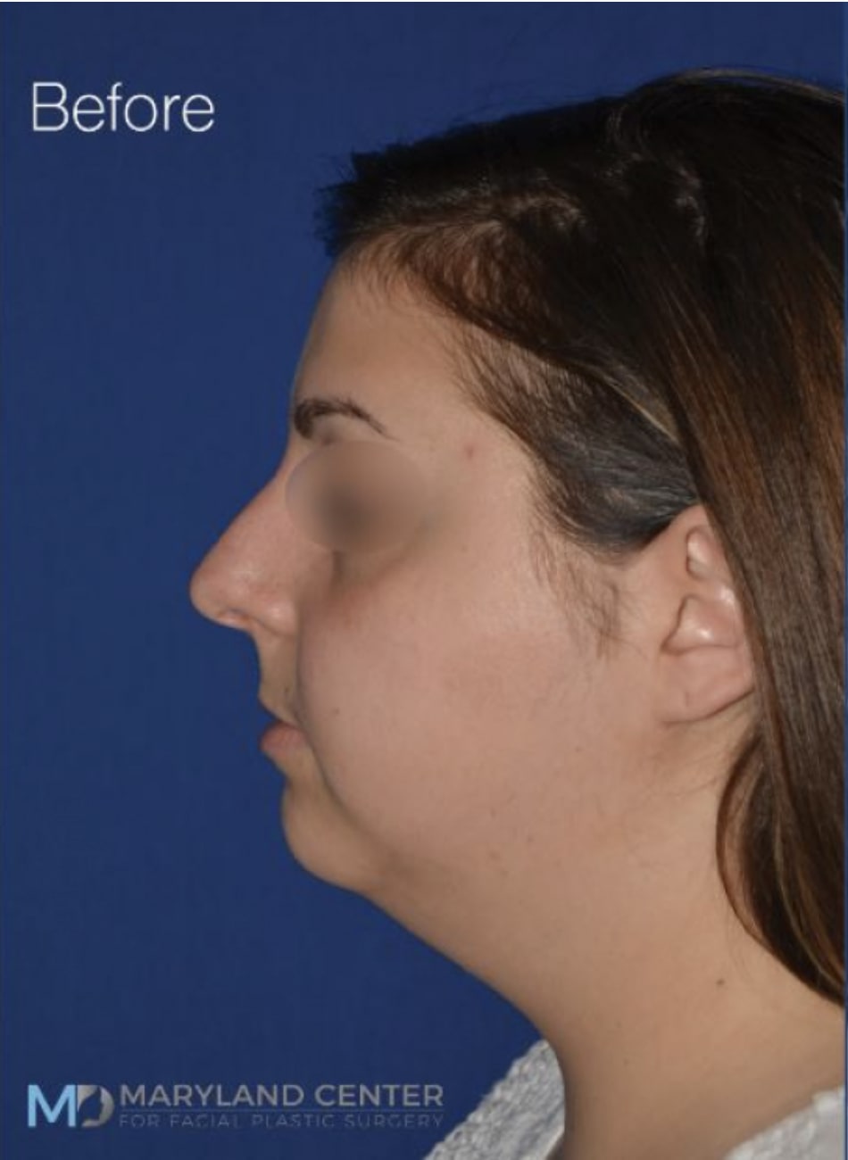 Liposuction Before, Female 23 - 3020