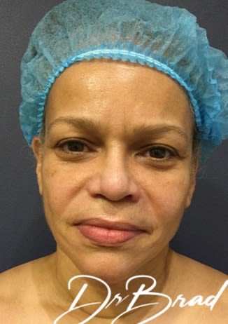 Facelift Before, Female 53 - 3081