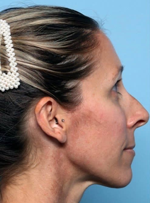 Rhinoplasty Before, Female 51 - 2294