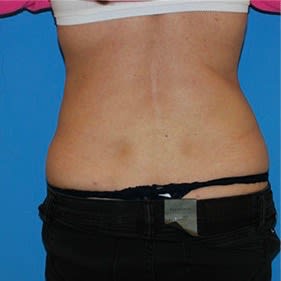 Tummy Tuck (Abdominoplasty) After, Female 35 - 2907