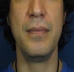 Chin Augmentation Before, Male 41 - 2799