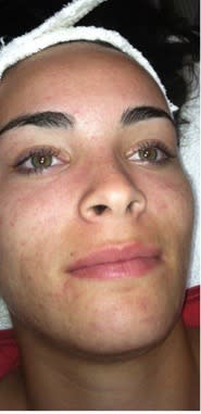 Acne Scar Solutions After, Female 28 - 2339