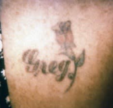 Laser Tattoo Removal Before, Female 42 - 2423