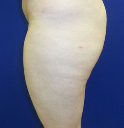 Cellulaze™ After, Female 32 - 3061