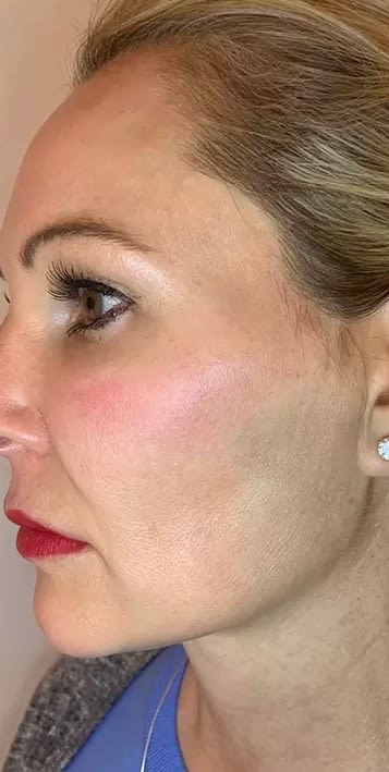 Dermal Fillers & Injectables After, Female 44 - 2842