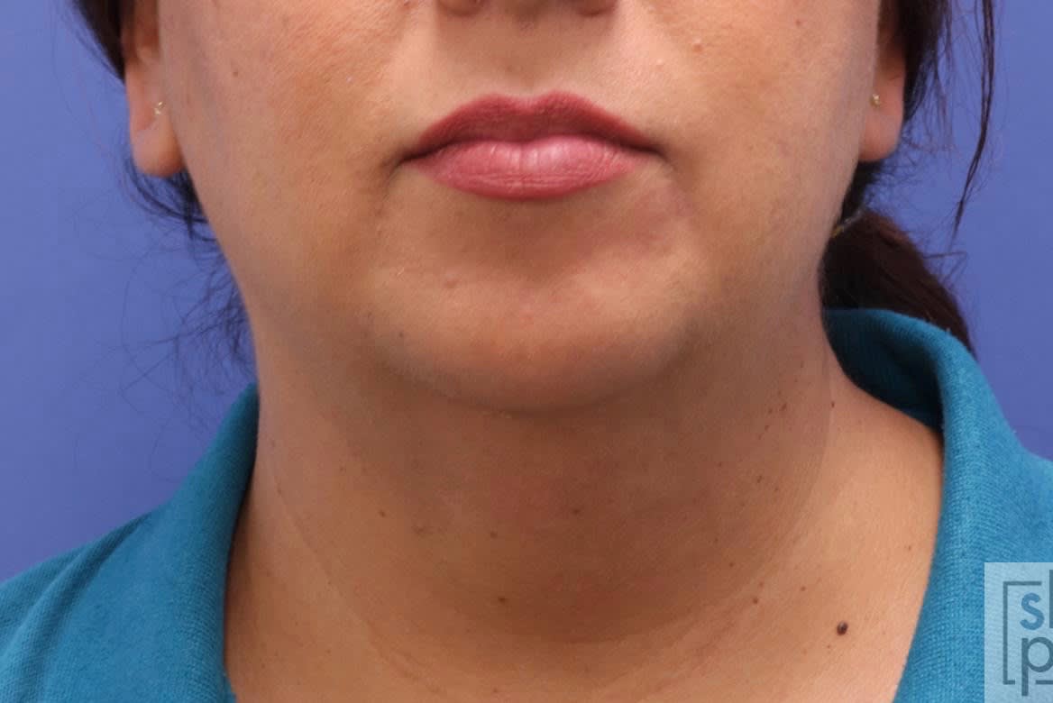 Chin Reduction Before, Female 39 - 1961