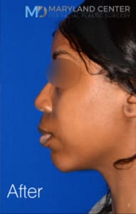 Chin Enhancement Solutions After, Female 33 - 1850