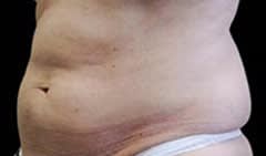 CoolSculpting® Before, Female 28 - 1077
