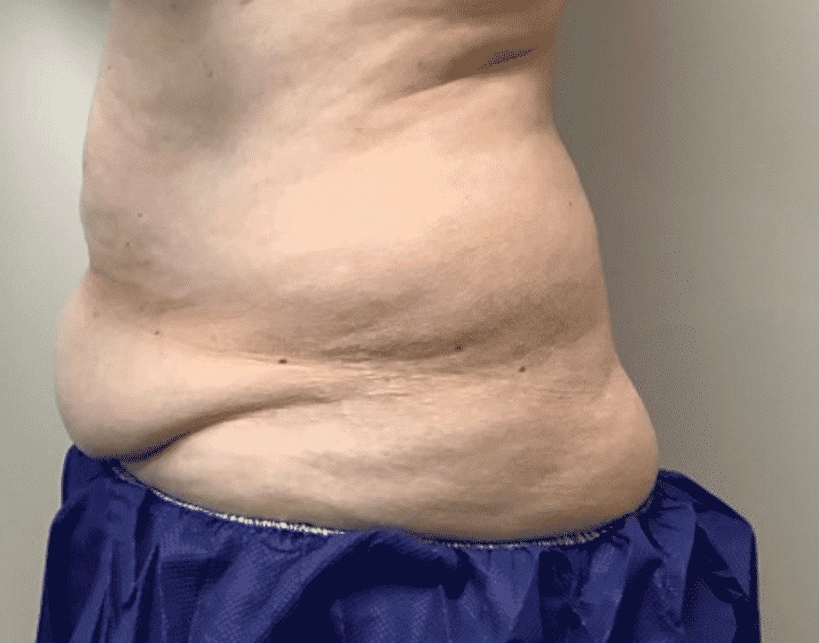 CoolSculpting® Before, Female 45 - 3383