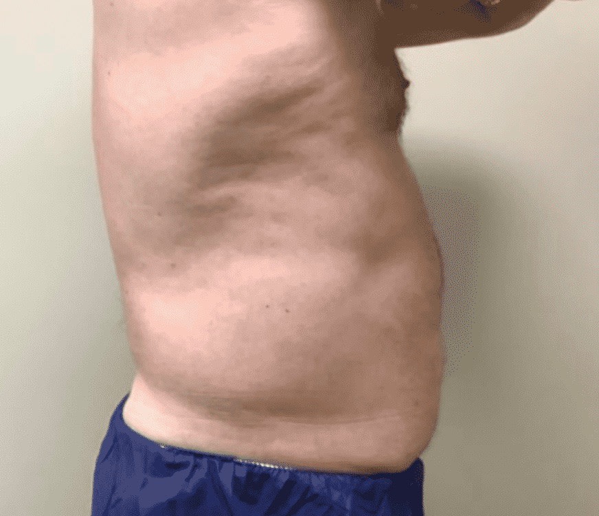 Abdominal Slimming Solutions After, Male 54 - 3384