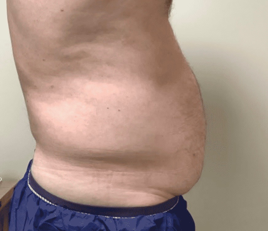 Abdominal Slimming Solutions Before, Male 54 - 3384