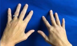 Hand Rejuvenation with Dermal Fillers After, Female 60 - 2844