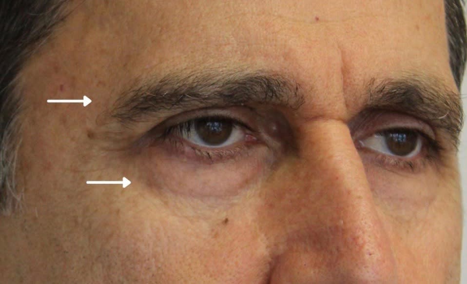 Brow Lift Before, Male 56 - 1720