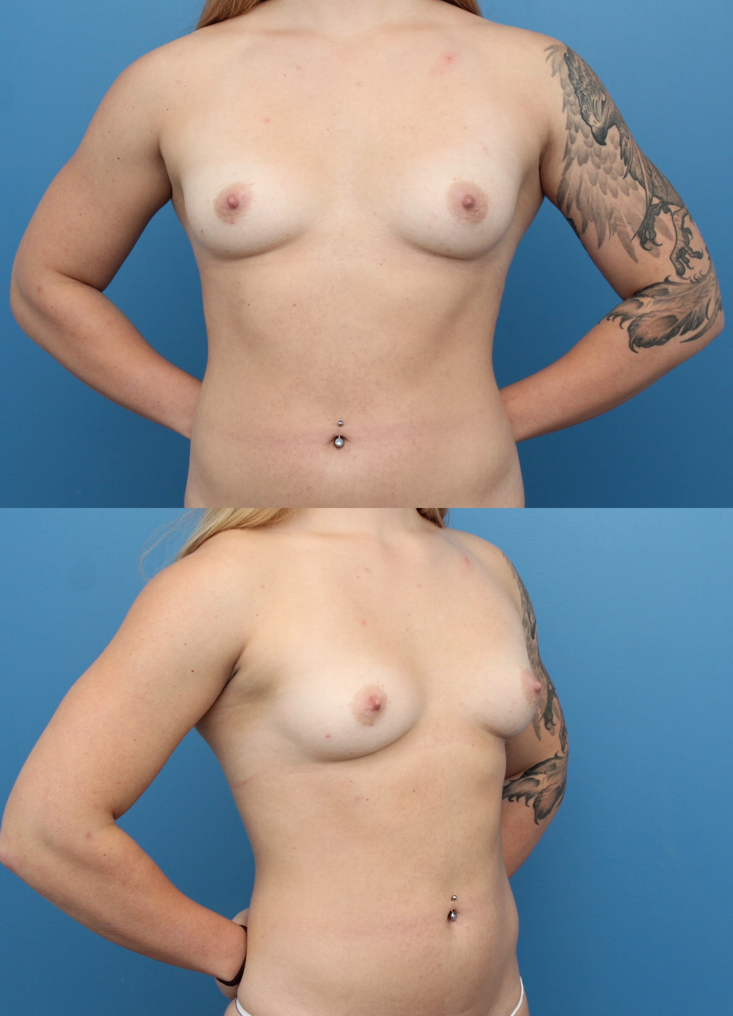 Breast Augmentation (Augmentation Mammaplasty) Before, Female 33 - 1406