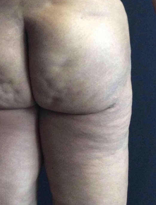 Cellulite Removal After, Female 35 - 2346