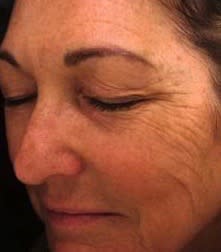 Skin Resurfacing Solutions Before, Female 50 - 2340