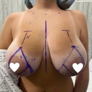 Breast Reduction Before, Female 27 - 2065