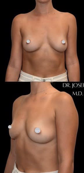 Breast Augmentation (Augmentation Mammaplasty) Before, Female 27 - 2059