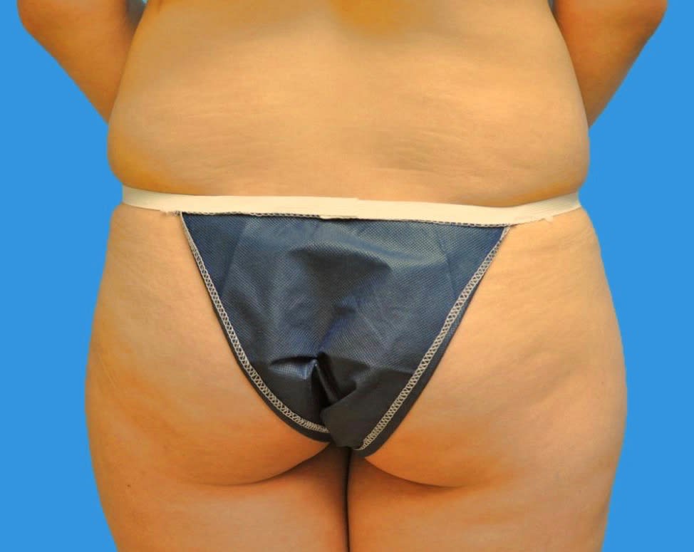 Buttocks Enhancement Solutions Before, Female 30 - 1950