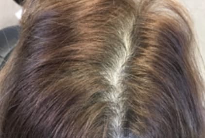 Hair Restoration Before, Male 45 - 4843