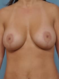 Breast Augmentation with Implants After, Female 43 - 4662