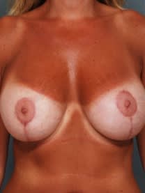 Breast Augmentation with Implants After, Female 49 - 4663