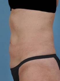 CoolSculpting® After, Female 60 - 4621