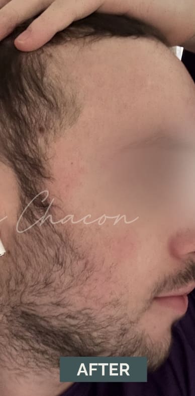 Acne Treatment After, Male 31 - 4829