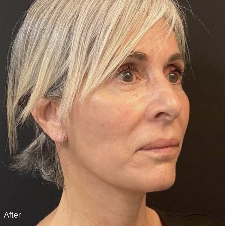 Facelift After, Female 57 - 4815