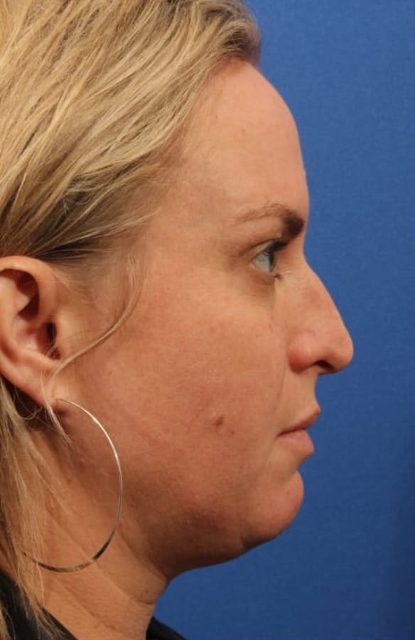 Rhinoplasty Before, Female 35 - 4826
