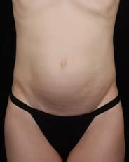 Abdominoplasty Before, Female 28 - 4683
