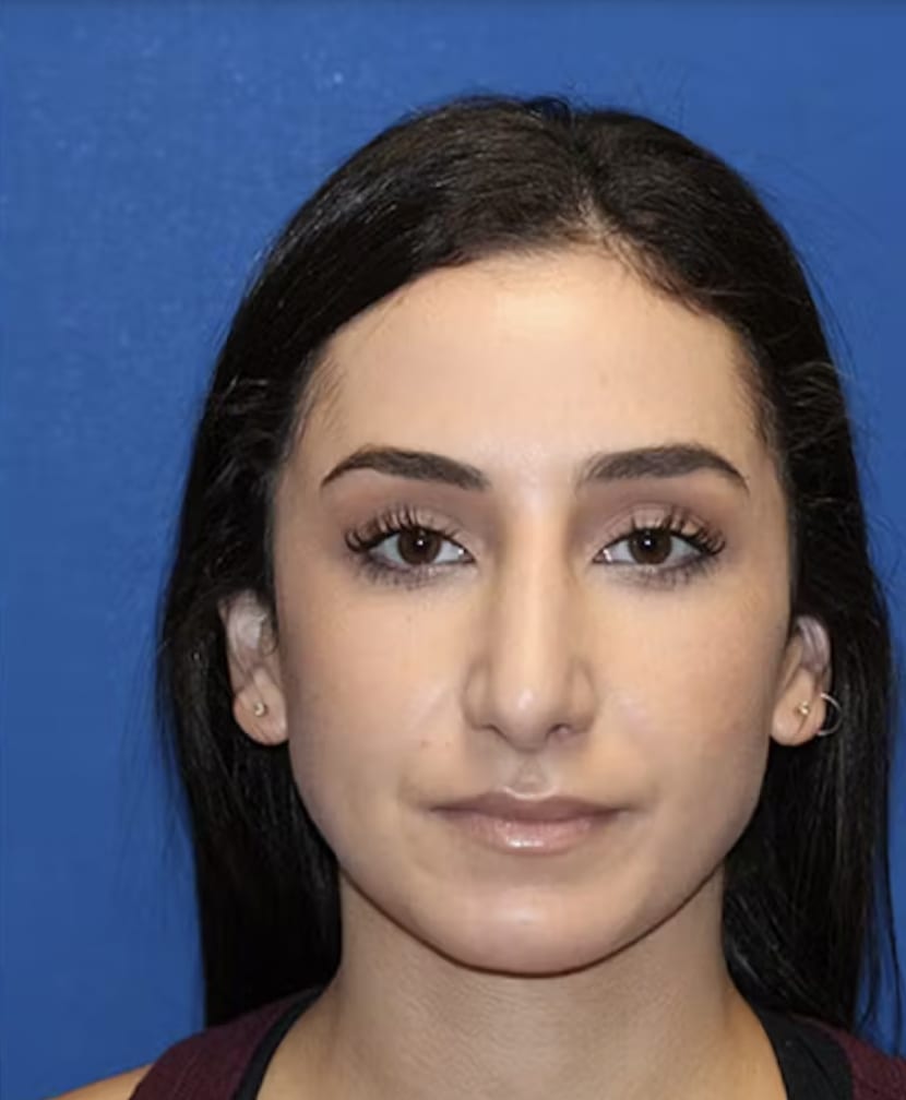 Rhinoplasty After, Female 26 - 4832