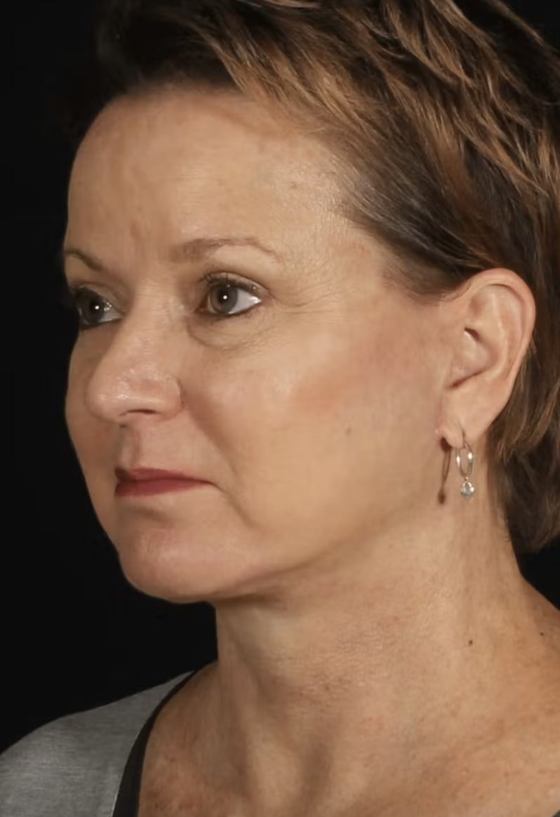 Neck Lift After, Female 55 - 4796