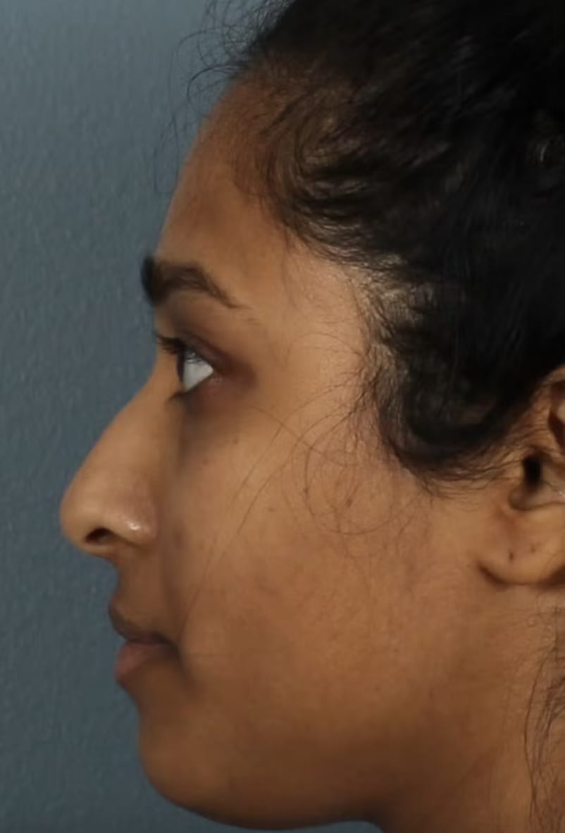 Rhinoplasty Before, Female 29 - 4781