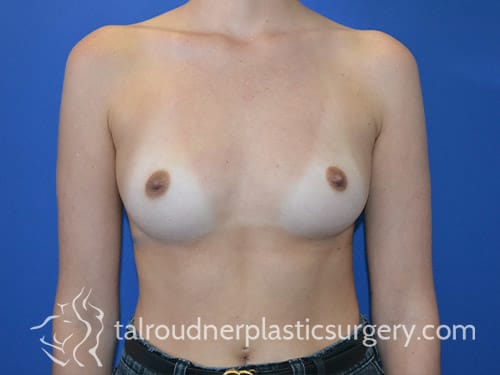 Breast Augmentation with Implants Before, Female 23 - 4767