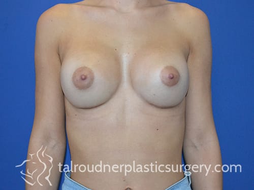 Breast Augmentation Solutions After, Female 22 - 4771