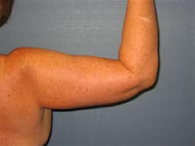 Arm Lift After, Female 55 - 4693