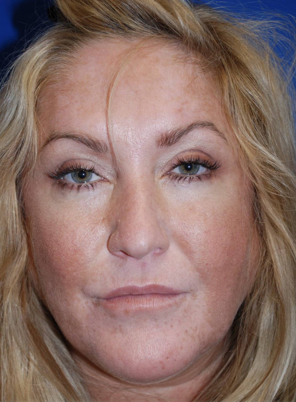 Facelift Before, Female 44 - 4627