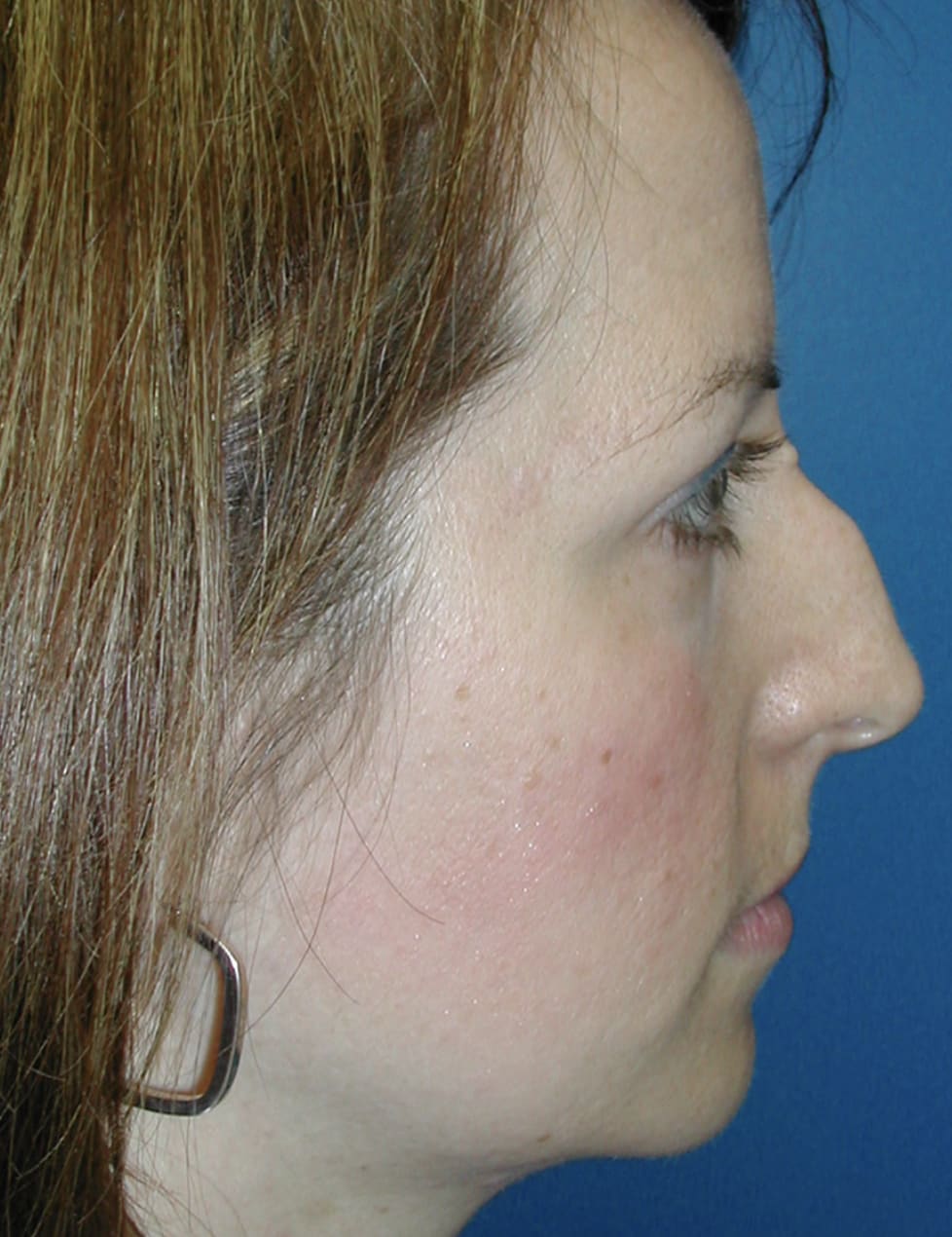 Rhinoplasty Before, Female 34 - 4626