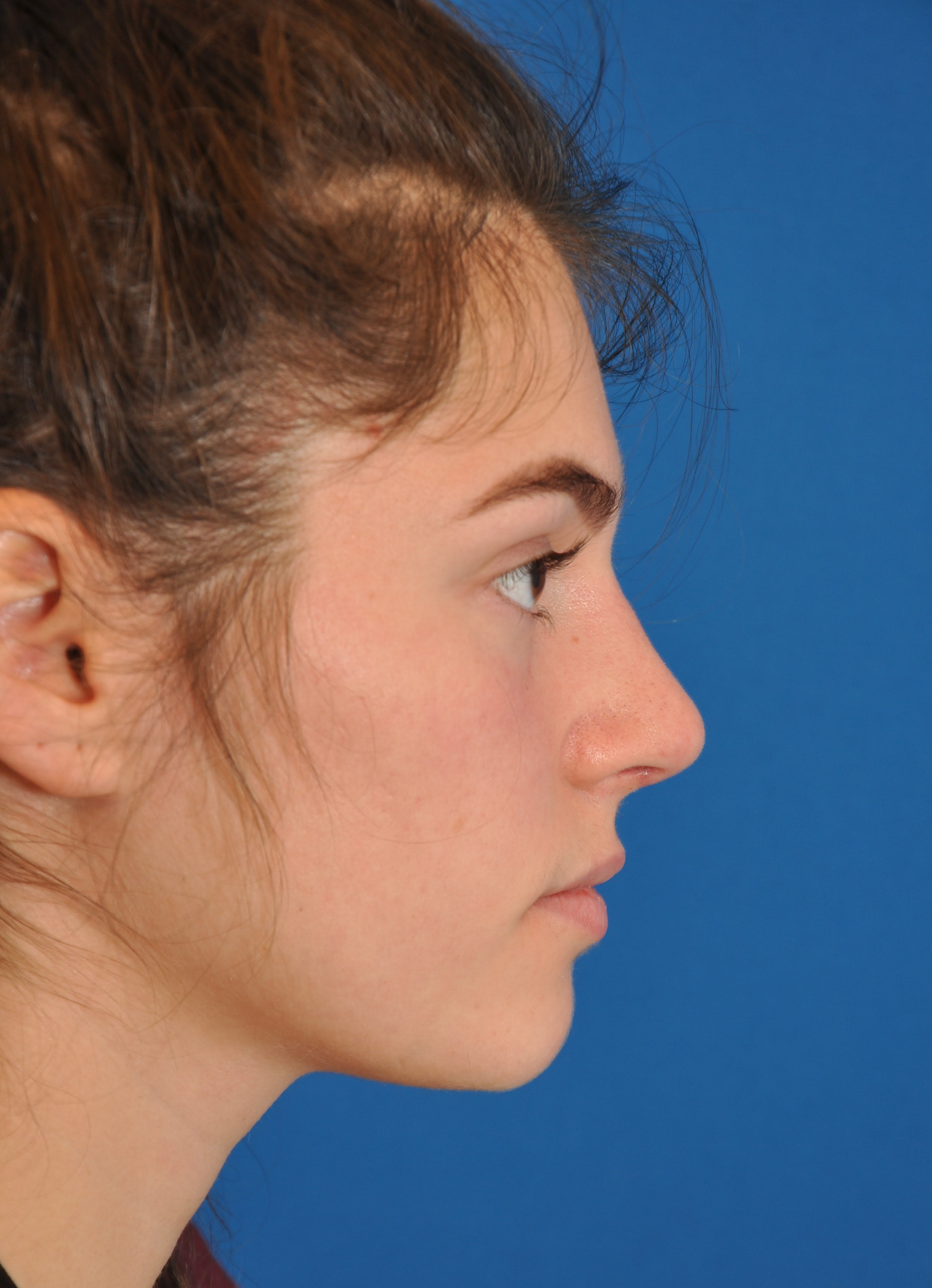 Rhinoplasty After, Female 20 - 1383