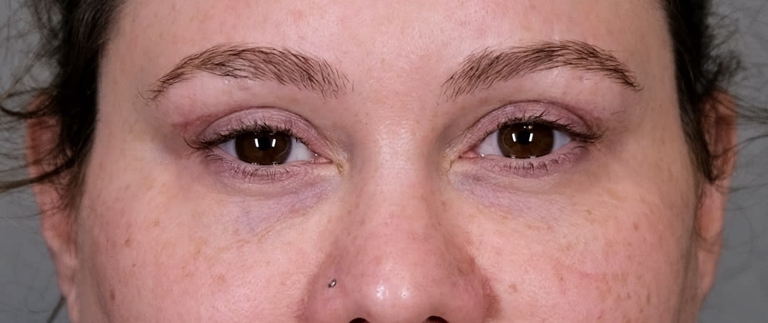 Blepharoplasty After, Female 40 - 1533